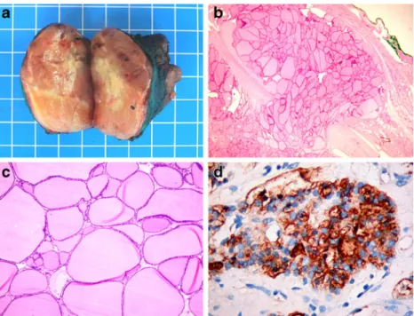 Fig. 1 a Macroscopical aspect of the macrofollicular variant of follicular thyroid carcinoma