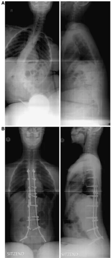 Fig. 1 (a) Sitting ap and lateral radiographs preoperative (b) postoperative