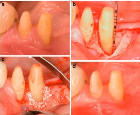 Fig. 3 Preoperative radiograph of the defect depicted in Fig. 2. A deep intrabony defect is visible