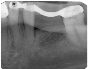 Fig. 4 Postoperative radiograph of the defect depicted in Fig. 2 demonstrating defect fill at 24 weeks following surgery