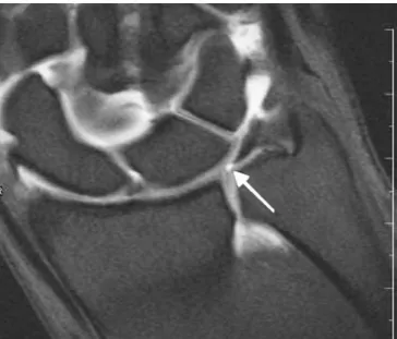 Fig. 3 Ulnar-sided peripheral triangular fibrocartilage tear. Coronal T1-weighted fat-suppressed MR arthrogram demonstrates an  ulnar-sided peripheral triangular fibrocartilage tear