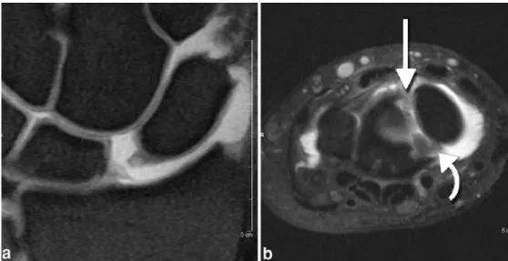 Fig. 6 De Quervain’s synovitis.