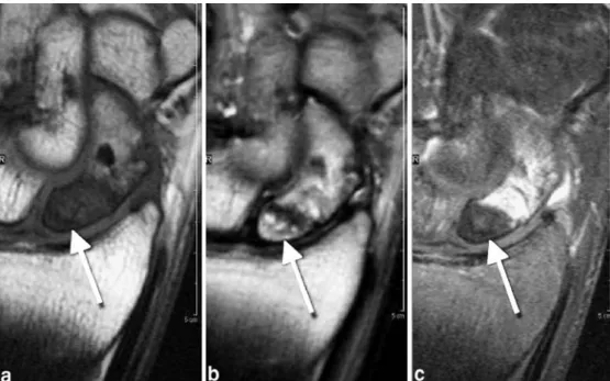 Fig. 8 Scaphoid pseudarthrosis with reparative changes in the proximal fragment. Hypointense proximal fragment on coronal T1-weighted image (a),  hyper-intense on  proton-density-weighted fat-suppressed image (b), followed by enhancement on T1-weighted fat