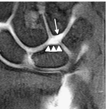 Fig. 12 Cartilage defect, hamate-lunate facet (type II lunate).