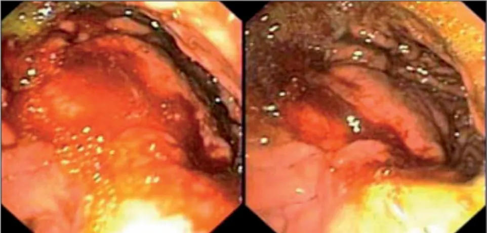 Abbildung 3. Endoskopie des Magens: großes, polypoides, derbes, kontaktvulnerables Areal  an der Korpushinterwand.