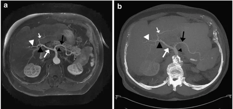 Table 2 Assessment of image quality of the abdominal aorta and its visceral branches on parallel gradient-echo magnetic resonance images of 102 patients