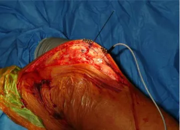 Fig. 2 LDF probe in situ in the patella ligament. The customized probe holder is shown sutured to the tissue