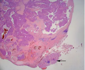Fig. 2 When cut open, the specimen shows the presence of a solid tumor. A capsule seems to be present