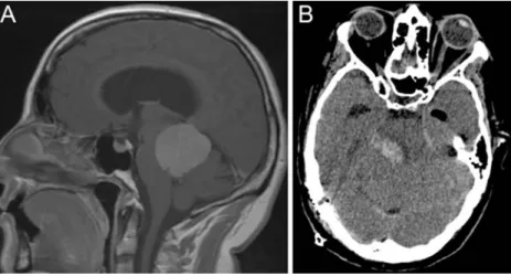 Fig. 3 Images from the patient (female, 47 years) with stable MEP and severe new motor deficit postoperatively