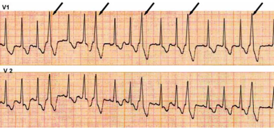 Fig. 2 ECG V1 and V2 pre- pre-cordial leads at 3 months, 4 and 9 years old (A, B and C, respectively) showing RBBB pattern and ST segment  anoma-lies