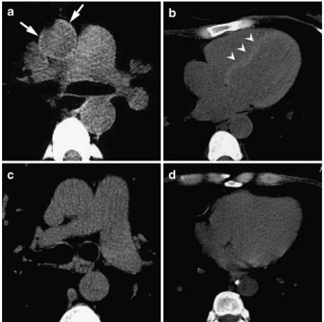 Table 1 Performance of the three diagnostic parameters (aortic CT attenuation value, aortic ring sign, and  interven-tricular septum sign) in  detect-ing anemia, both separately and combined