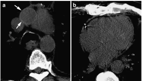 Fig. 2 Unenhanced CT at the level of main pulmonary artery (a) and the ventricular level (b) in a man with mild anemia (hemoglobin, 12 g/dl) shows true-positive aortic ring sign (arrows) against false-negative interventricular septum sign