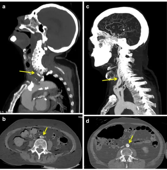 Fig. 3 Influence of the perfusion volume on the filling of the venous system (example, pulmonary arteries)
