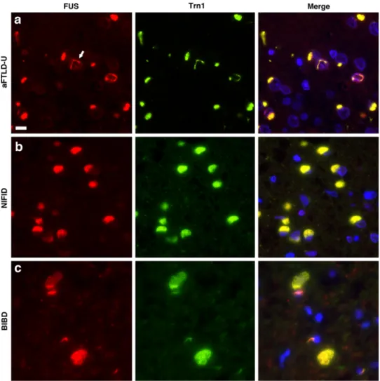 Fig. 2 Co-localization of Trn1 and FUS in all FTLD-FUS subtypes. Double-label immunofluorescence for FUS (red) and Trn1 (green), with DAPI staining of nuclei in the merged images