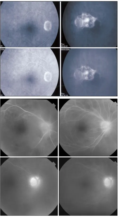 Fig. 2 A 64-year-old female with partial traumatic optic nerve avulsion with Fuchs’
