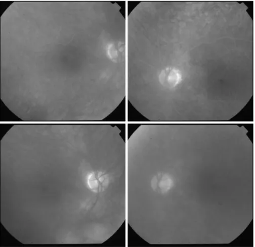 Fig. 5 Peripheral vascular leakage in a young female showing typical KPs, heterochromia, cataract and vitreous cells 1?