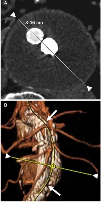 Fig. 3 Stretched vessel view demonstrating the 3D volume mea- mea-surement of the same abdominal aortic aneurysm as in Figs