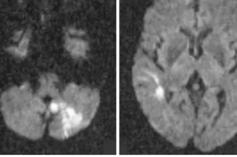 Fig. 2 Pattern 6: Cardioembolic stroke (atrial fibrilla- fibrilla-tion): DWI shows hyperintense lesions in the  poste-rior circulation (2a: left posterior inferior cerebellar artery) and in the right anterior circulation (2b:  MCA-territory)