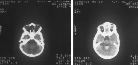 Fig. 1 Initial pre-operative axial computed tomography scan without (left) and with (right) iodine contrast showing a rounded, homogenous contrast enhancement situated just behind the fourth ventricle