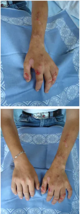 Fig. 3 Pre-operative dermatological finding showing prurigo lesions strictly in the left arm without a specific dermatome distribution
