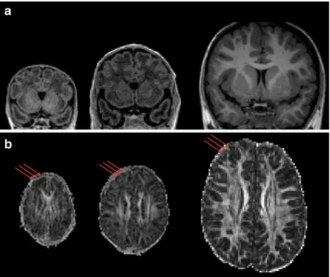 Fig. 2 Computation of the hemispheric gray matter surface (40,971 vertices) in the longitudinally scanned subject at age 33 PCW, 40 PCW and 6 years