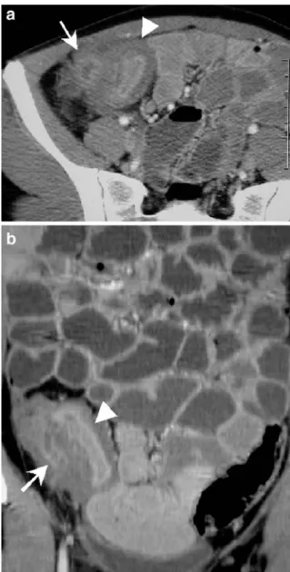 Fig. 3 CTE in a 22-year-old woman with complicated Crohn ’ s disease: diffuse parietal thickening of the distal ileum (arrowhead) and surrounding inflammation causes luminal narrowing  compli-cated by an intraperitoneal abscess (arrow), both seen on a axia
