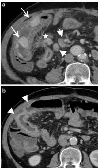 Fig. 6 CTE in a 40-year-old woman with Peutz-Jeghers disease detected after recurrent episodes of intestinal intussusceptions:  mul-tiple pedunculated jejunal and ileal hamartomas (arrows) are nicely seen within the distended bowel loops, 34 among them wer