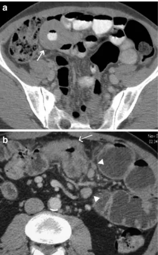 Fig. 9 CTE in a 79-year-old patient presenting with melena of unknown origin: arterial phase nicely demonstrates the intensely contrast-enhanced infracentrimetric polyp situated in a distal jejunal loop (arrow), exactly depicted thanks to optimal luminal d