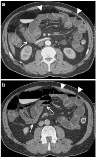Fig. 11 A 48-year-old woman with long-standing Crohn’s disease and high-grade ileal stenosis impossible to overcome by endoscopy: