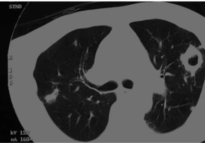 Figure 2. Thoracic CT scan showing a pulmonary abscess in contact with the pericardium and chest wall, mediastinal adenopathies,  infil-trates and pleuro-parenchymatous synechia in the lingual lobe.