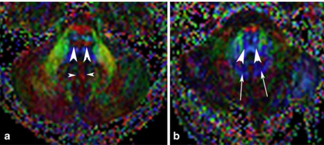 Fig. 3 Fiber tracking, posterior view: a control; b current case.