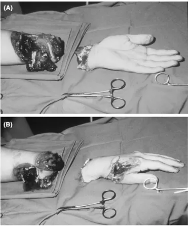 Fig. 2. Long-term result at 12 years after crush amputation (see Fig. 1) showing considerable forearm shortening of 12 cm (A)