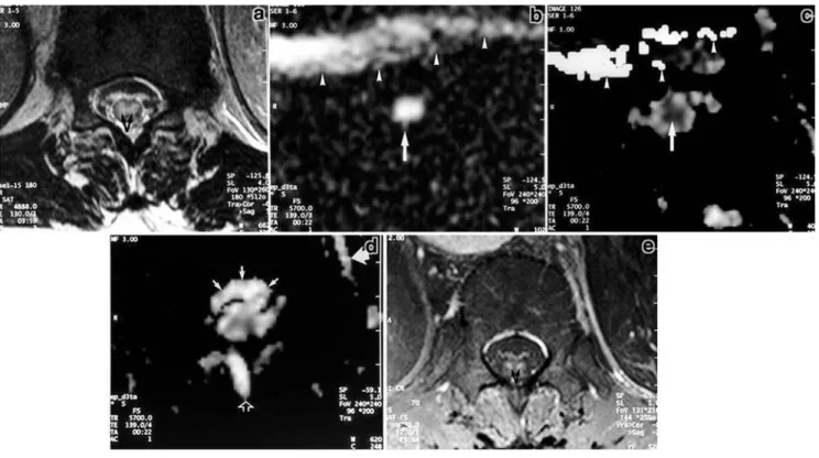 Fig. 3 a–e Patient 5. a Axial T2-weighted image at T11 12 h after the onset of symptoms onset shows a large area of high signal centrally in the spinal cord (arrows)