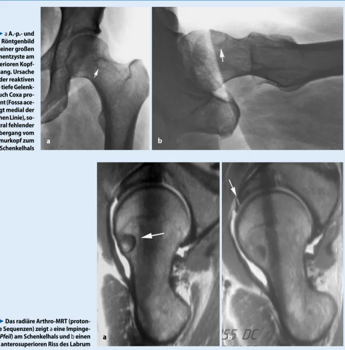 Abb. 4  7  Das ra di äre Ar thro-MRT (pro ton- ton-gewich te te  Se quen zen)  zeigt a eine Im   m ent zys te  (Pfeil) am Schen kel hals und b einen  an te ro supe rio ren  Riss  des  La brum