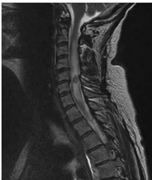 Figure 1. MRI of the spinal cord.