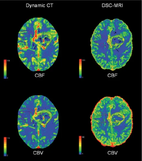 Figure 1. Parametric perfusion maps of patient #  7 . Increased rCBF and rCBV are observed in  both DSC-MRI and dynamic CT