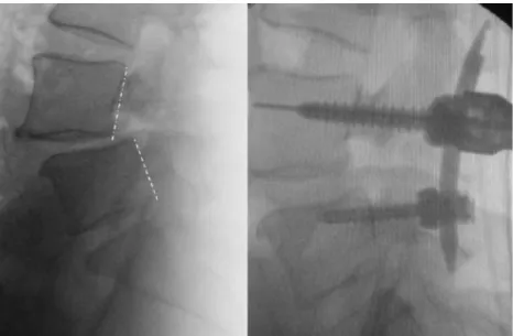 Fig. 1 Intraoperative lateral views before (left) and after (right) unilateral instrumentation and interbody distraction showing reduction of the spondylolisthesis
