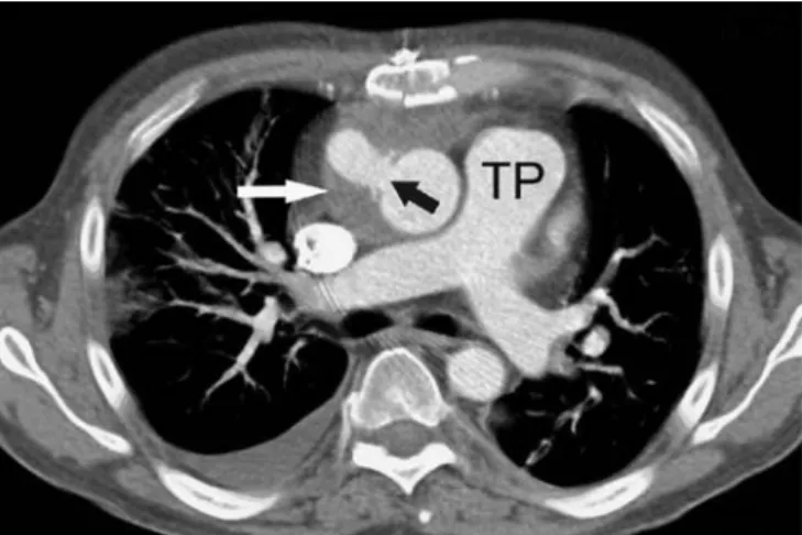 Fig. 6 A 47-year-old male patient who underwent surgery for an intracorporeally placed Berlin Heart Incor as a bridge-to-transplant.