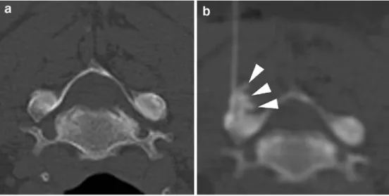 Fig. 1 48 year-old female with neck pain since 4 months and 100% pain relief after sole  pe-riarticular FJB