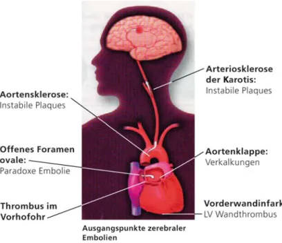 Abbildung 1. Das Herz als Ursache embolischer Ereignisse in der Zerebralzirkula- Zerebralzirkula-tion (Abdruck mit Genehmigung von D