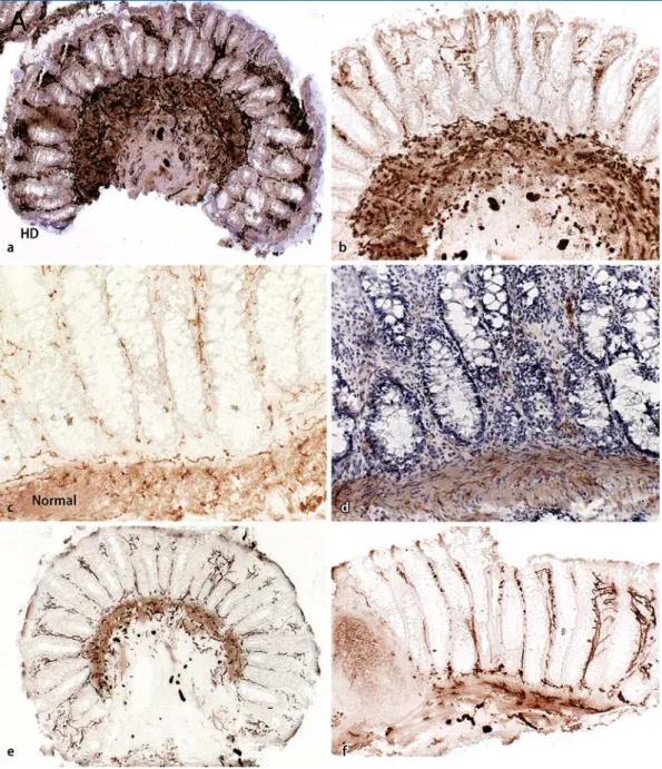 Abb. 1  8  Rektumschleimhautbiopsien. a Biopsie 3,5 cm ab ano bei einem 3-jährigen Jungen mit klassischem M