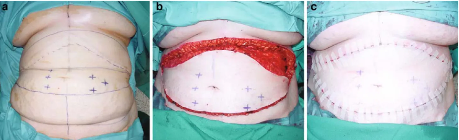 Fig. 2 (a) Preoperative planning with suprapubic and submammary incisions and six marked perforator vessels on periumbilical skin island (asterisks)