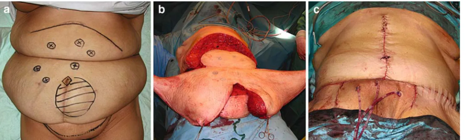 Fig. 4 Fleur-de-Lys abdominoplasty intraoperative views. (a) Preoperative view with abdominal perforators marked