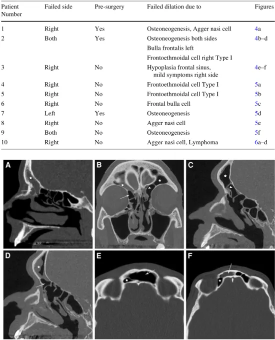 Fig. 4 a (Patient 1): severe  osteoneogenesis of the frontal  sinus/frontal recess (star) with  an agger nasi cell (arrow)