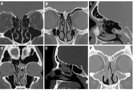 Fig. 6 (Patient 10) a Preoperative CT scan showing chronic rhinosi- rhinosi-nusitis of the frontal recess (star)