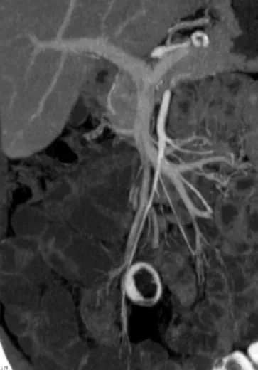 Fig. 3 Enlarged section of an axial plane of abdominal MDCT in a 57-year-old woman after oral preparation with neutral contrast medium (mannitol)