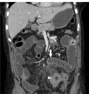 Fig. 6 Coronal plane of abdominal MDCT in a 54-year-old woman, prepared with orally administered positive contrast medium (Megluminioxitalamat, Telebrix Gastro, Guerbet, France)