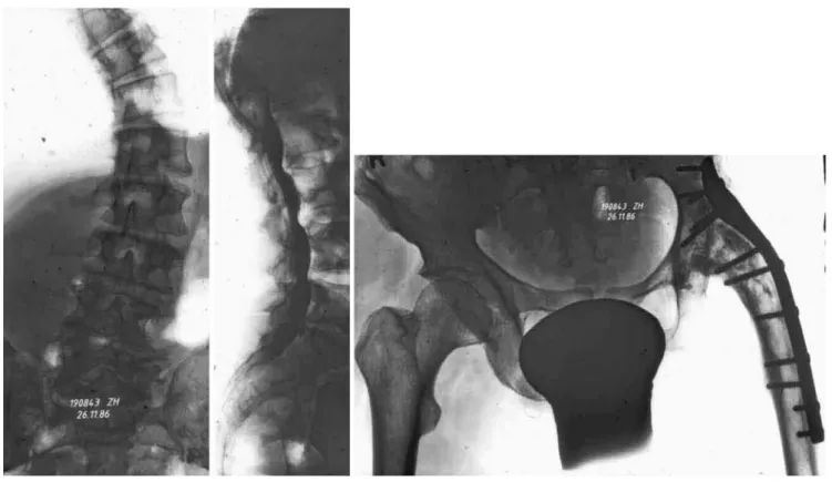 Fig. 6 Type 3a scoliosis in a 25-year-old female patient. Arrows (1) transitional anomaly; (2) spondylolysis L5
