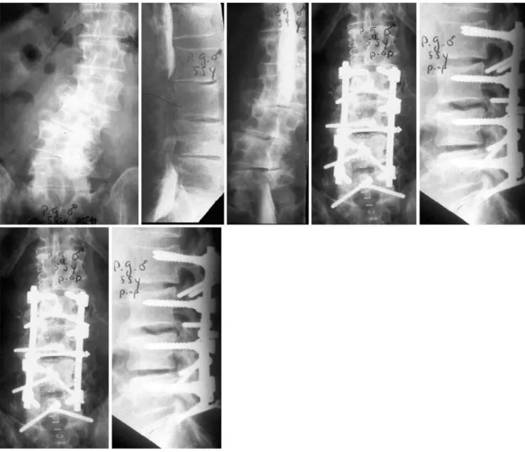 Fig. 8 Adult scoliosis in a 55-year-old male patient with M.