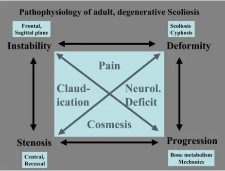 Fig. 10 Pathophysiology of adult, degenerative scoliosis with its clinical presentation